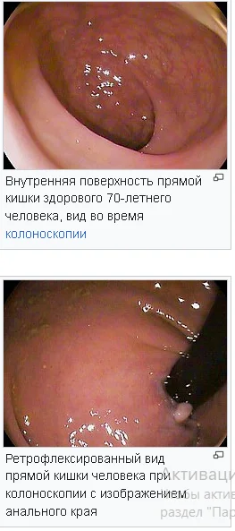 эти фото здоровые у людей толстый кишечник и прямая кишка и сам кишечник&nbsp;