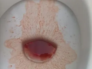 покакал с кровью