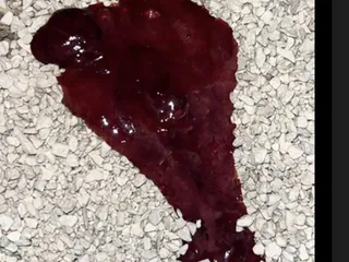 Кровь в камушках